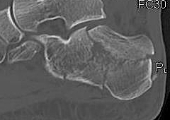 Calcaneal Fracture Lateral CT